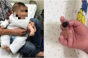 Bé 6 tháng tuổi hoại tử tay, phải cắt cụt vì thói quen nhiều mẹ thường làm cho con