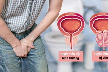 Dấu hiệu của bệnh viêm tiền liệt tuyến ở nam giới