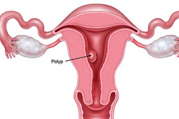 Polyp nội mạc tử cung: nguyên nhân và phương pháp điều trị