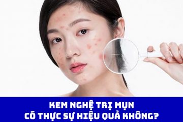 Kem nghệ trị mụn có thực sự hiệu quả không? Hướng dẫn cách sử dụng